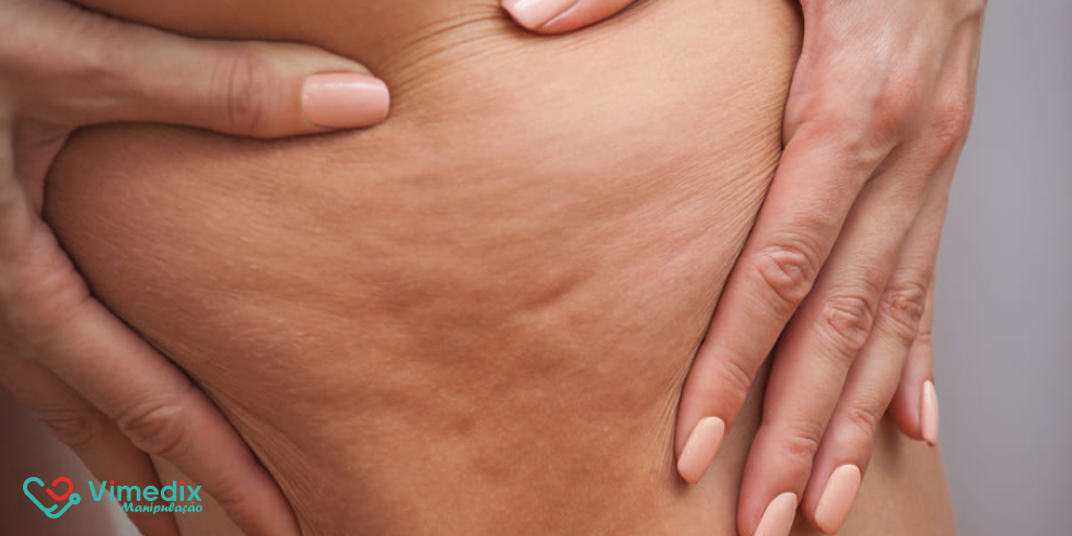 Por que o composto anticelulite da Vimedix é o ativo natural ideal para o combate à celulite?