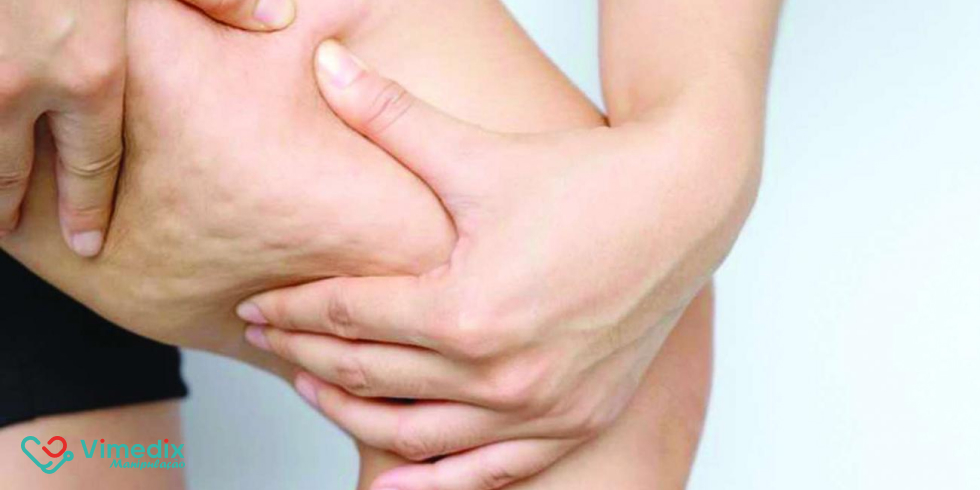 Quais são as principais vantagens do composto anticelulite da Vimedix para a sua saúde?