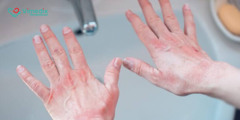 Blog | Vimedix - Farmácia de Manipulação Dermatite Atópica: Como os Lactobacilos Podem Ajudar no Tratamento