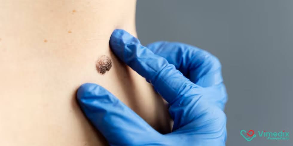 Podofilina 25%: Tratamento Eficaz para Verrugas Genitais e Condilomas  
