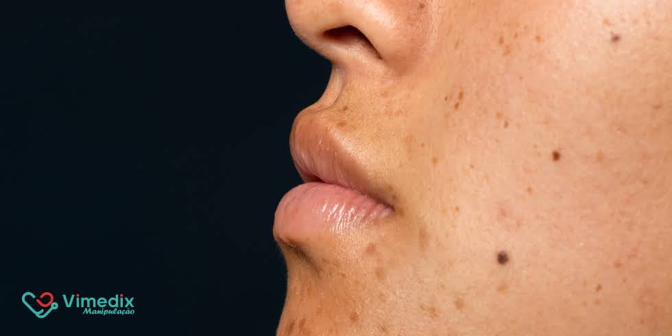 Blog | Vimedix - Farmácia de Manipulação Sérum Clareador: O Poder dos Ácidos Contra Manchas e Melasma