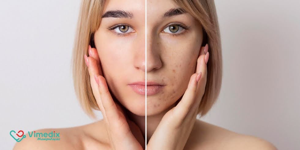 Blog | Vimedix - Farmácia de Manipulação Sérum Clareador: O Poder dos Ácidos Contra Manchas e Melasma